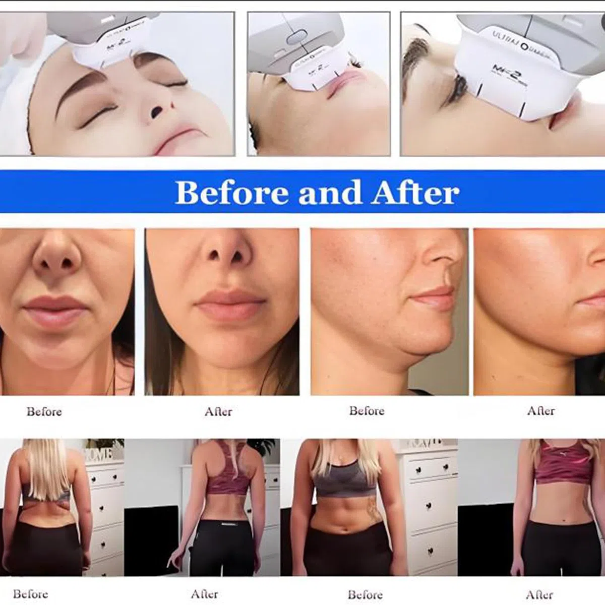 Máquina Profesional para reafirmar la Piel del Rostro, Antiarrugas, Adelgazante y antienvejecimiento, con 7 Cartuchos,para Eliminar Arrugas Faciales,Seguro E Indoloro para Antiarrugas